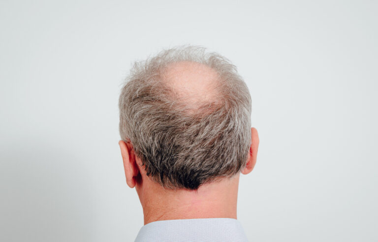 Quais os tipos de alopecias? Meu caso tem solução?
