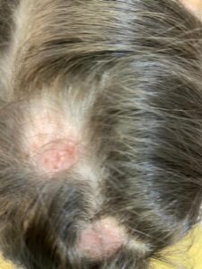 TINEA CAPITIS (FUNGO)