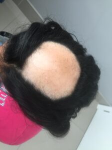ALOPECIA AREATA
