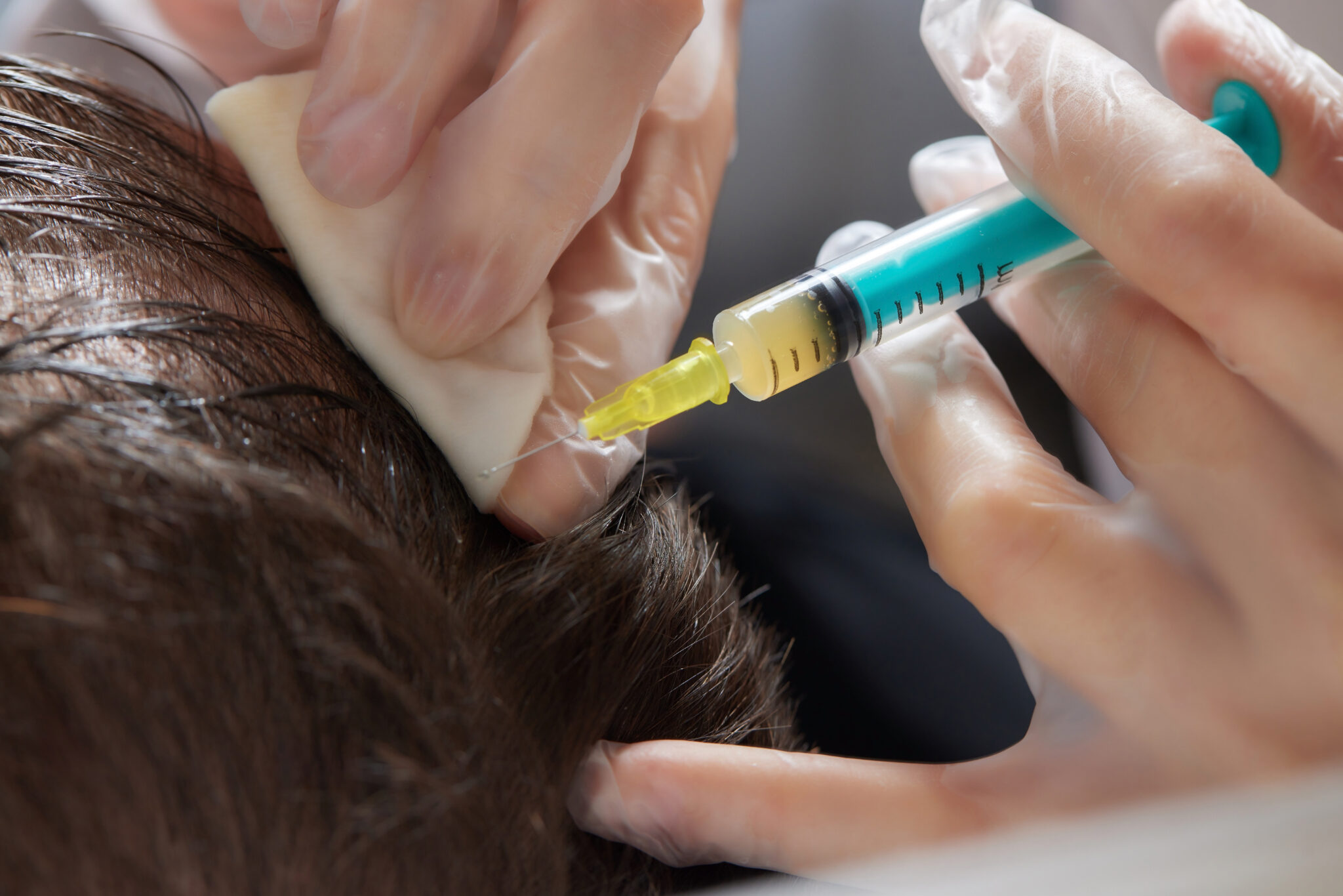 Terapias Regenerativas no Tratamento da Queda de Cabelo